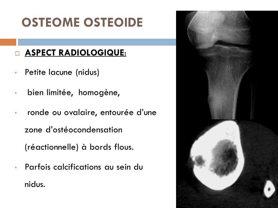 IMAGERIE DES TUMEURS OSSEUSES BENIGNES ppt video online télécharger